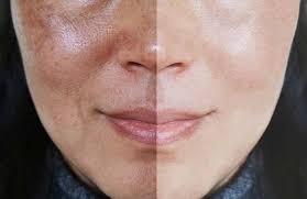 Pigmentation Treatment